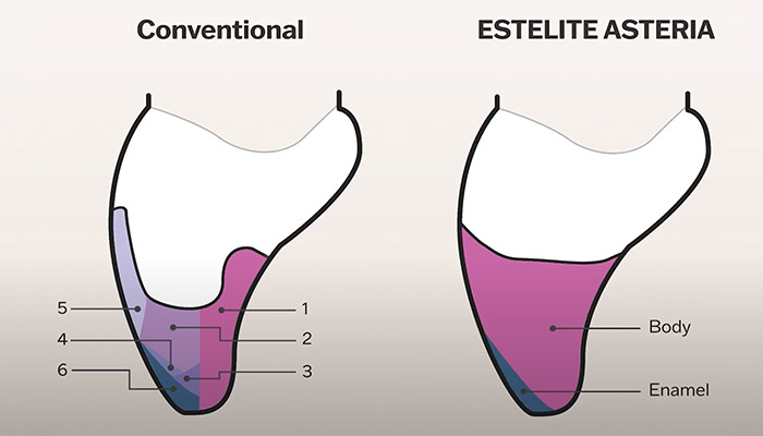 Simple layering technique with ESTELITE ASTERIA